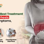 What Is the Best Treatment for Liver Cirrhosis – Causes, Symptoms, Prevention