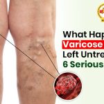 What Happens If Varicose Veins Are Left Untreated? 6 Serious Risks