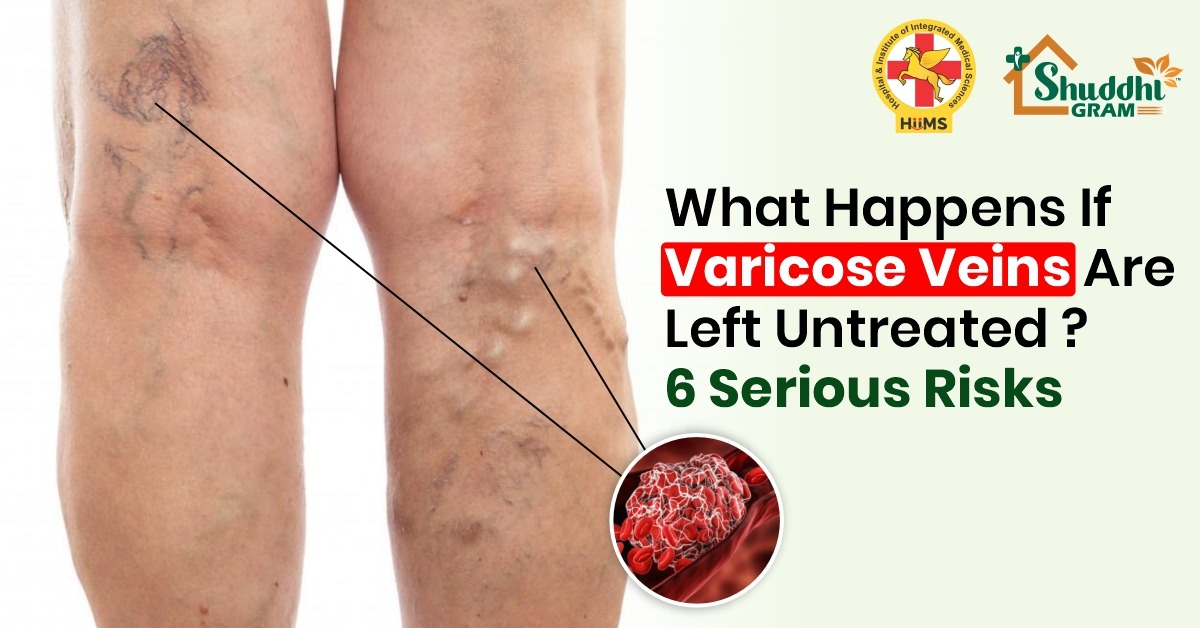 long-term effects of varicose veins
